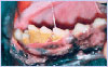 Unhealthy gums and teeth